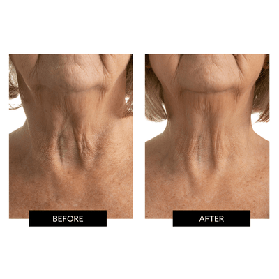 CurrentBody Skin LED Neck and Dec Perfector - urządzenie ledowe na szyje i dekolt
