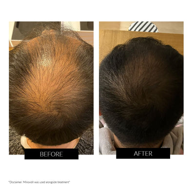 CurrentBody Skin LED Hair Regrowth - urządzenie na porost włosów