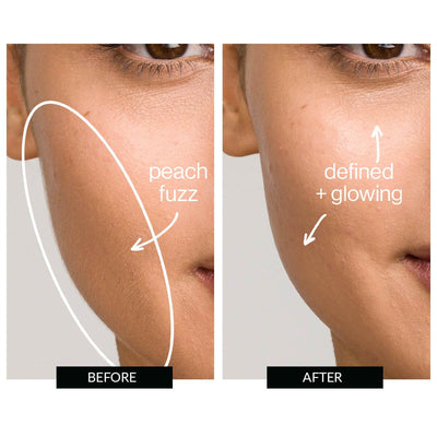 DERMAFLASH Luxe Facial Exfoliation and Peach Fuzz Removal Device